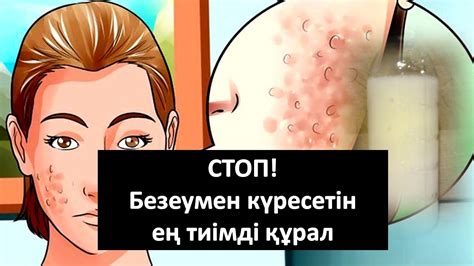 "Болтушка" безеумен күресетін ең тиімді құрал - YouTube