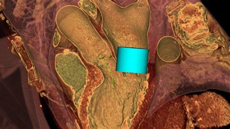 Ct Cardiac Advanced Visualization Package Terarecon