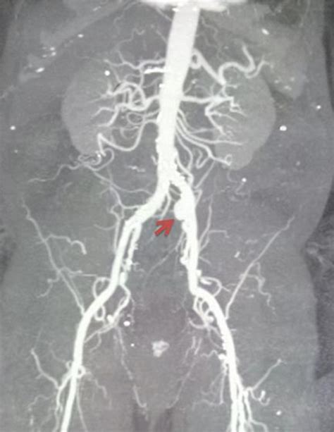 Figure 1 From Endovascular Management Of An Isolated Common Iliac Artery Aneurysm A Case Report