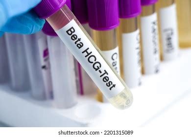 Urine Samples Testing Hcg Laboratory Urine Stock Photo