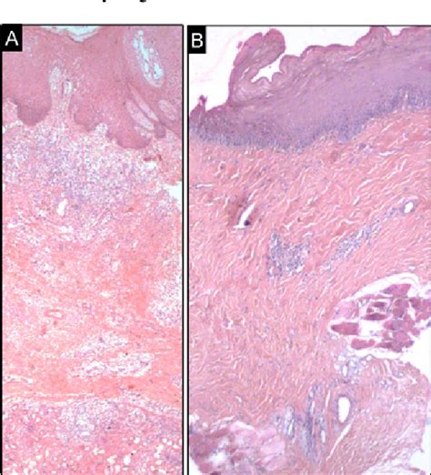 Oral Submucous Fibrosis Histopathology