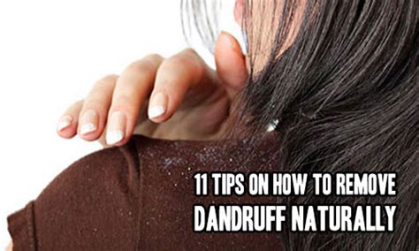 11 Tips On How To Remove Dandruff Naturally Iseeidoimake