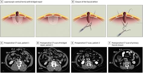 Primary Fascial Closure During Minimally Invasive Ventral Hernia Repair