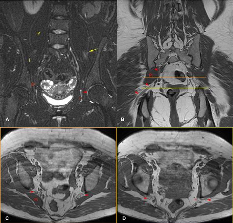 Lumbar Plexus Mri