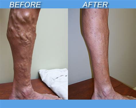 Varicose Comprehensive Vein Center Symmetry Vascular