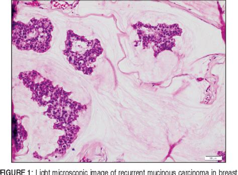 Figure 1 From Pituitary Gland Metastasis Of Breast Cancer A Rare Case