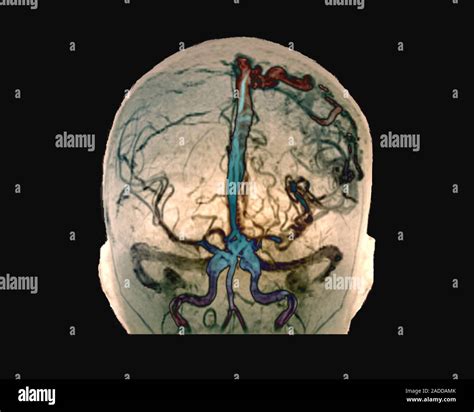 Cerebral Arteriovenous Malformation Coloured Frontal D Computed