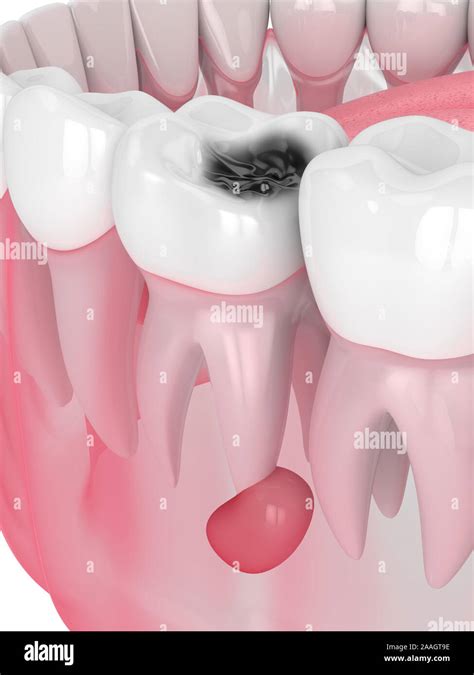 D Render Of Jaw With Tooth Cavity And Cyst Dental Problem Concept