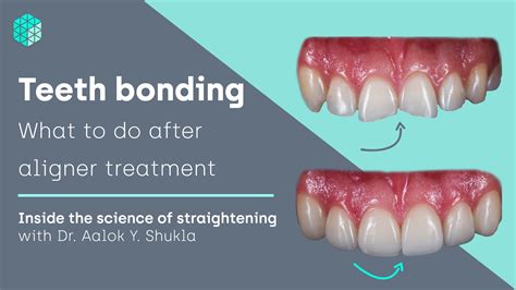 Dental Bonding Rockville Centre Ny Cosmetic Teeth Bonding