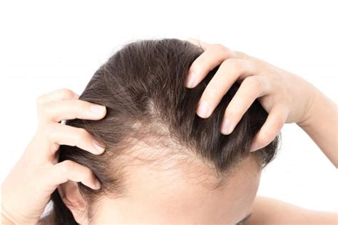 Laser Light Hair Loss Therapy Hair Loss Clinic Toronto