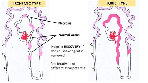 Pathology Of Acute Tubular Injurynecrosis Pathology Made Simple