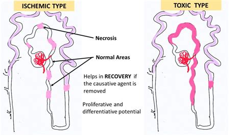 Pathology Of Acute Tubular Injury Necrosis Pathology Made Simple