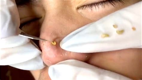 Pimple Popping 2020 Video 06 Blackheads Whiteheads And Inflamed