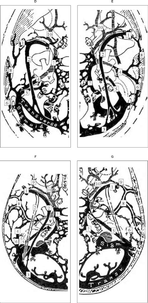 Figure From Anatomic Variations Of The Superficial Middle Cerebral