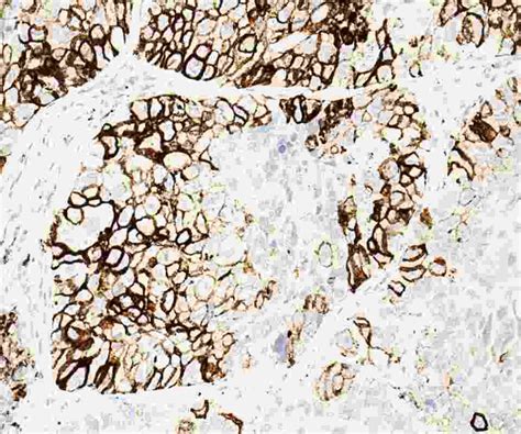 Lazertinib Plus Amivantamab Vmjw Approved For Nonsmall Cell Lung