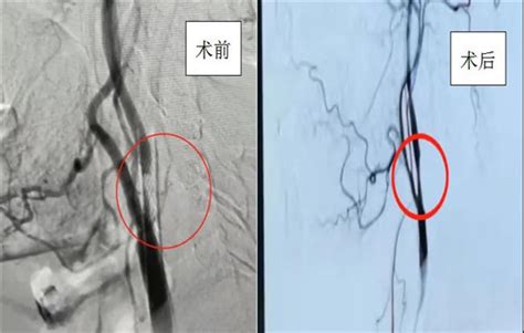 神经内科二病区成功完成1例颈内动脉支架植入术 企业官网