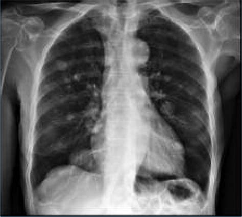 Chest Radiography Posterior Anterior Incidence With Several Bilateral