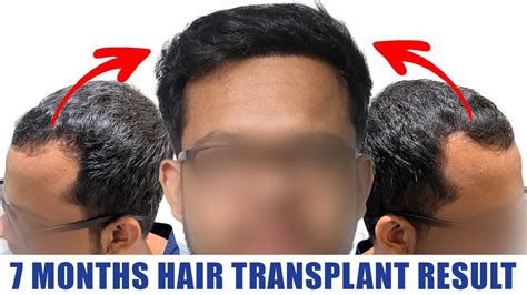 Best Hair Transplant Clinic In India Hair Mate Clinic Result 7 Months Hair Transplant