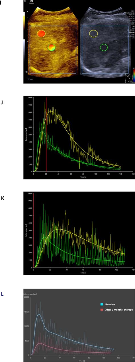 Application Of Dynamic Contrast Enhanced Ultrasound Analysis In