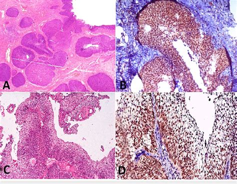 A Showing Invasive Nests Of Basaloid Cells In A Case Of Basaloid Scc