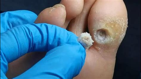 Pedicure Tutorial How To Treat Plantar Wart Plantar Wart Removal A