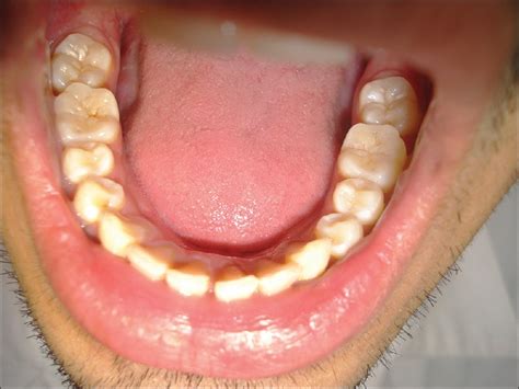 Occlusal Morphology Of Permanent Mandibular First And Second Molars In