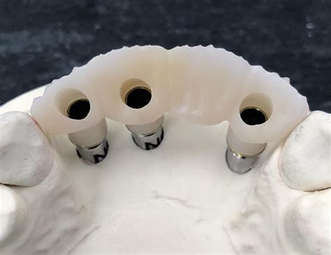 DYNAMIC TIBASE CASE Dynamic Abutment Solutions EN