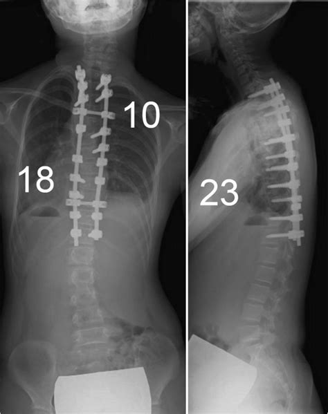 Postoperative X Rays Postoperative X Rays Show That The Scoliosis Was