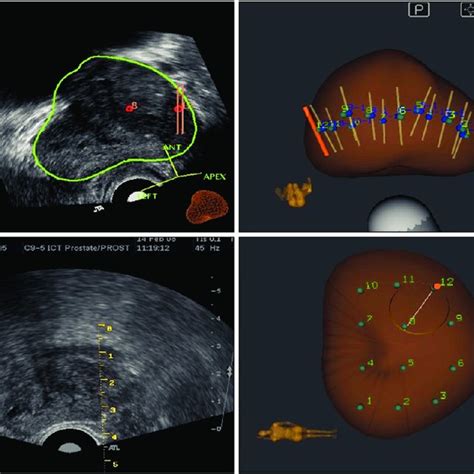 Pdf Multiparametric Magnetic Resonance Imaging Transrectal Ultrasound