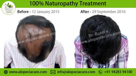 Alopecia Areata Treatment Types Causes