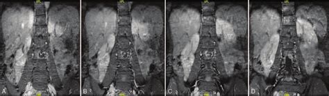 A D Preoperative Coronal Mri Scan Revealing The Density Of Soft