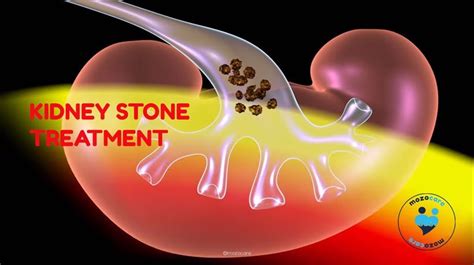 Kidney Stone Treatment In India - Mozocare - Find Healthcare Abroad