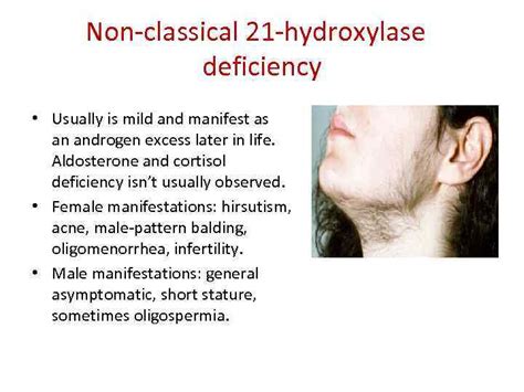 Congenital Adrenal Hyperplasia Marina Nodelman Md The Diabetes