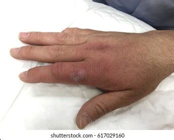 Skin Disease Lesion Ecchymosis Vasculitis