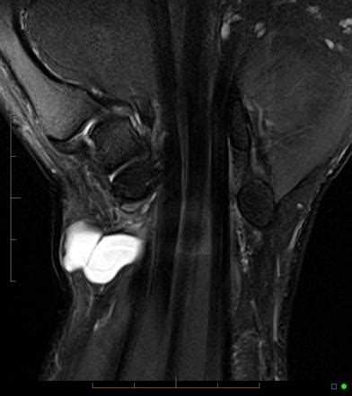 Ganglion cyst | Radiology Reference Article | Radiopaedia.org