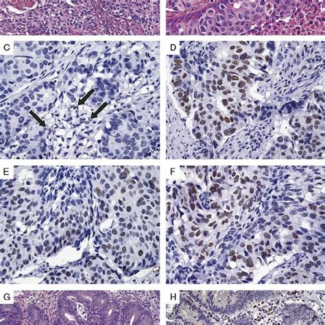 High Grade Endometrial Adenocarcinoma A And B In A 77 Year Old Woman