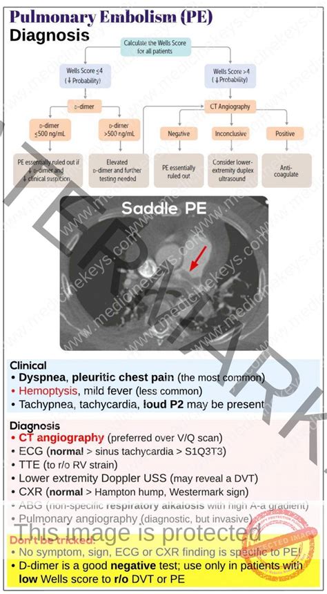 Pulmonary Embolism PE Diagnosis Medicine Keys For MRCPs