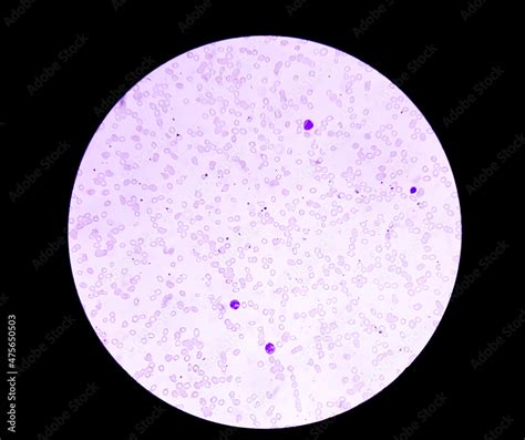 Macrocytic Anemia With Features Of Hemolysis And Nucleated Rbc Analyzed