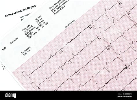 Close Up Of Ecocardiography Report Ecg Showing Irregular Heartbeat