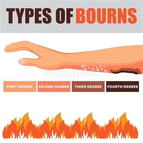 Burn Skin Fire Stock Illustrations 612 Burn Skin Fire Stock