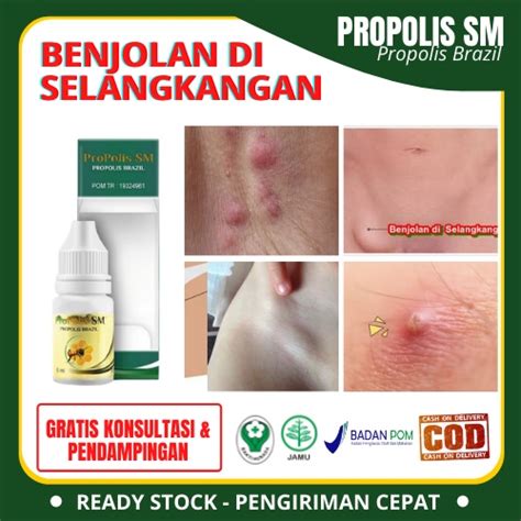 Jual Obat Benjolan Di Selangkangan Penghancur Benjolan Di Selangkangan