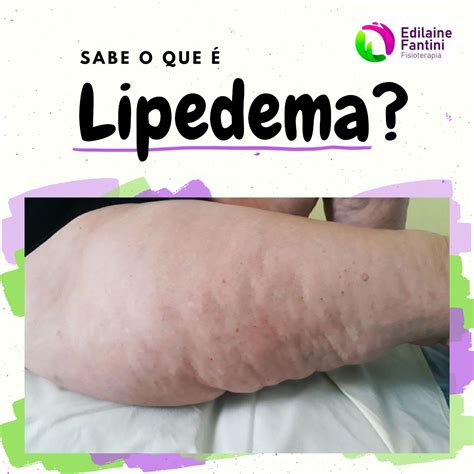 Voc Sabe O Que Lipedema Em Jundia Sp Not Cias Solutudo