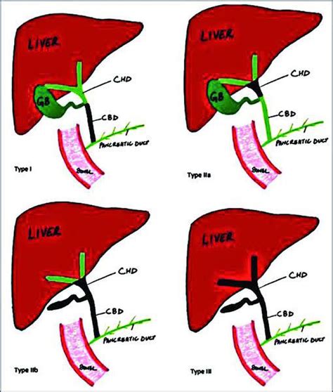 Biliary Atresia Classification MEDizzy