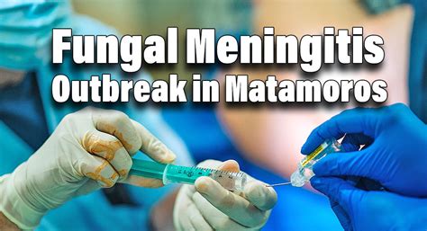 Fungal Meningitis Outbreak in Matamoros - Mega Doctor News