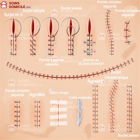 Les Points De Sutures Quelles Rôles Pour Linfirmier Soinsdomicilema