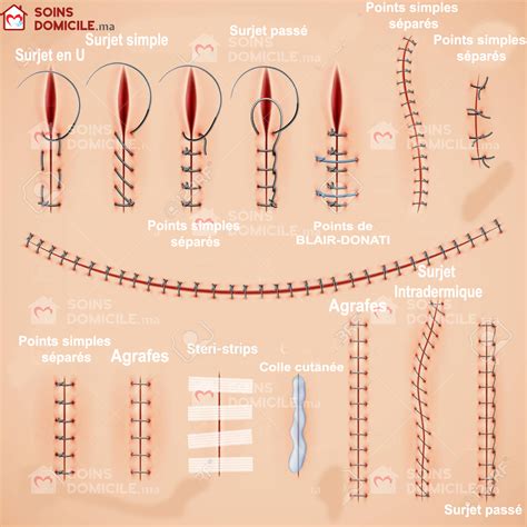 Types Of Sutures Used In Hysterectomy at Diane Duerr blog