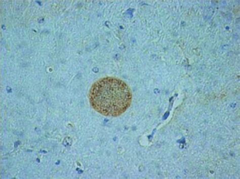 Toxoplasmosis Gondii Cysts