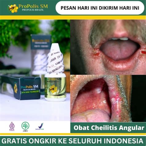 Jual Obat Cheilitis Angular Obat Munculnya Luka Di Sudut Bibir Obat