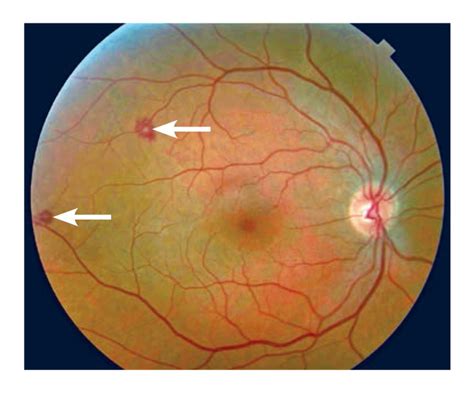 Roth Spots Endocarditis