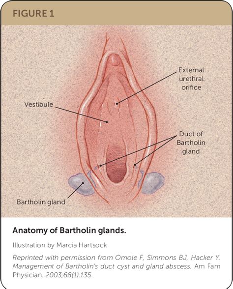 Figure 1 From Bartholin Duct Cyst And Gland Abscess Office Management